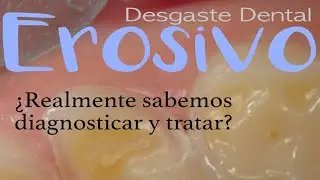 CONVERSATORIO 31 | Desgaste Dental Erosivo ¿Sabemos diagnosticar y tratar? | Gustavo Tello