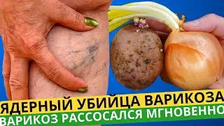УБИЙЦА ВАРИКОЗА! БЕРЕМ Лук, Картофель... и Через 3 Дня Ножки Были ЧИСТЫЕ!