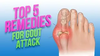 How to Reduce the Risk of Gout Attack
