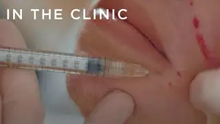 Combination injectables and lasers for early 40s | In the Clinic: Before and Afters | Nicola