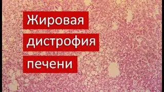 Жировая дистрофия печени | Патанатомия