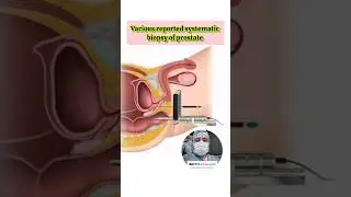 Various reported systematic biopsy of prostate. #youtubeshorts #trending #viral #video #neet #study