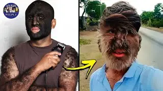 THE HUMANS WITH 'WEREWOLF SYNDROME' - UNUSUAL PEOPLE #2