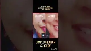 DIMPLE CREATION SURGERY RESULTS 😍👏👌🤩❤️