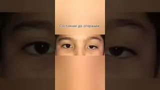 Методы лечения птоза верхнего века.