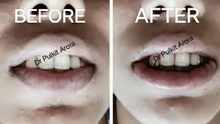 LIP REDUCTION SURGERY @SkintillateClinic