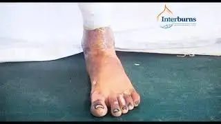 Burn physiotherapy: 6. Ankle & Foot