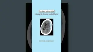 Intracranial Haemorrhages - OSCE Tips | UKMLA AKT CPSA