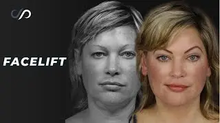 Dr. David Stoker's EXPERT Facelift and Upper Eyelid Surgery Results