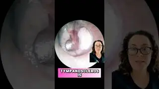 🦻🏻🥁 White Patches on Ear Drum?  It maybe tympanosclerosis #eardrum #earinfections #entdoctor