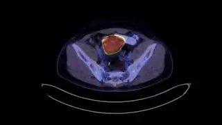 Robotic excision of loco-regional recurrence in colon cancer guided by ICG