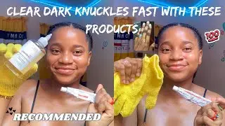 HOW TO CLEAR DARK KNUCKLES FAST IN SIMPLE STEPS | Get A Brighter & Healthy Skin