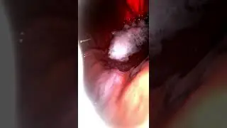 Lighting Up My Stomach w/ Flashlight | EndoCam
