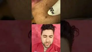 PROMINENT PORES on lips and chin