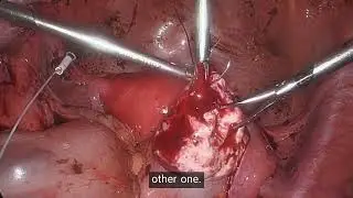 COR 436 Lap  endometriosis  DR F  Dabrowski 1109