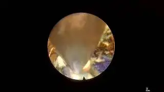 Spinal Stenoz Lateral Recess Dekompresyonu, Transforaminal Endoskopik Dekompresyon