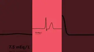 Hyperkalemia ECG Findings - Shorts