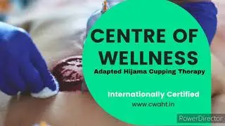 Hijama Cupping Therapy Results #hijama #cupping #painrelief #hijamainbangalore #Cuppinginbangalore