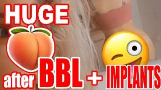 HUGE 🍑 after SUPERCHARGED BBL 🤤💖