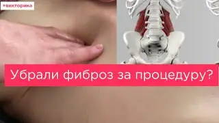 Популярное ЛОЖНОЕ ощущение у пациентов! Лечим Фиброз мышц поясницы. Миопрессура