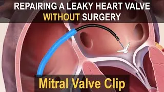 MITRAL VALVE CLIP (MitraClip/Pascal) | Repairing a Leaky Heart Valve without Surgery