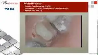 Clinical Tip: Reversed Core Build-up by Dr Jablow