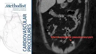 Inferior Epigastric Artery Pseudoaneurysm Coil Embolization (Mohamed, MD; Bismuth, MD; Zubair, MD)