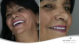 טיפולי שיניים בטורקיה עם ביונד סמייל - ריקי מתחדשת בחיוך החדש שחלמה עליו שנים