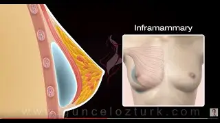 Breast Augmentation Surgery with Implants (3D Animation ) - Guncel Ozturk, MD - DRGO