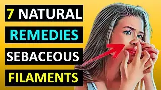 How to Get Rid of Sebaceous Filaments Naturally Using Home Remedies
