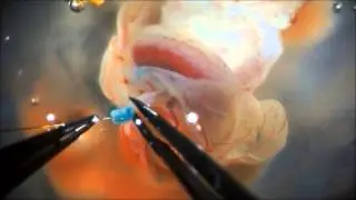 Cannulation of the umbilical artery
