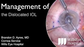 Management of Dislocated IOL's