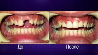 Какие есть виды протезирования зубов?