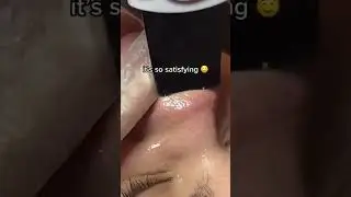 ultrasonic Skin Scruber