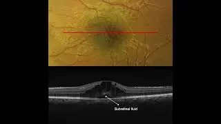 Cystoid Macular Edema in Pars Planitis, OCT Interpretation