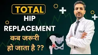 हेमी हिप रिप्लेसमेंट और टोटल हिप रिप्लेसमेंट के बीच अंतर - Total Hip Replacement ( 3D Animation )