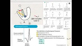 ecg 8