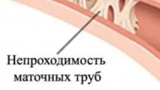НЕПРОХОДИМОСТЬ МАТОЧНЫХ ТРУБ. 🔴 Народная медицина.