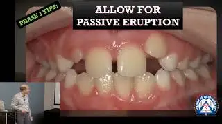 Clear Aligner Tip: Allow Passive Eruption