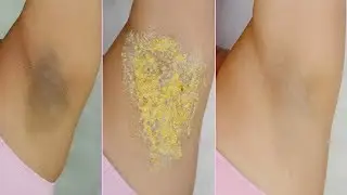 Como Blanquear Las Axilas Con Bicarbonato Y Agua Oxigenada