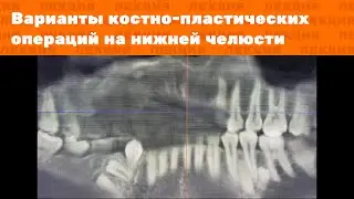 Лекция: Варианты костно-пластических операций на нижней челюсти
