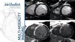 Cardiomyopathies I: Complementary Roles of Echo and CMR (Quiñones, MD & Shah, MD) February 4, 2020