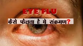 Eye FLU से बचने के उपाय