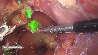 TLH with sentinel lymph node dissection in a woman with DIE
