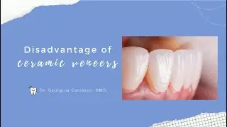 The disadvantage having Ceramic Veneers