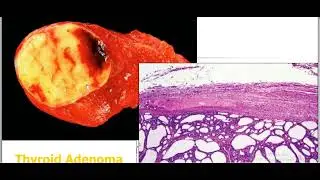 Neoplasia