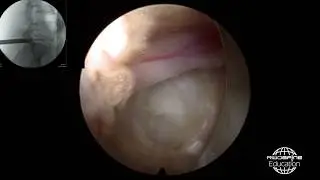 RIWOspine full-endoscopic spine surgery at lumbar Spine - Sept.2018