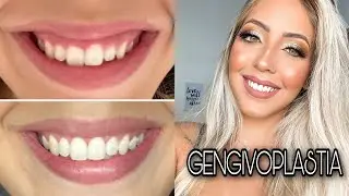 GENGIVOPLASTIA COM OSTEOPLASTIA: COMO FOI, PÓS OPERATÓRIO, PREÇO E MAIS! ♡Amanda Borges