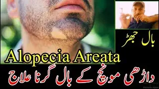 Balchar ka Elaj|Alopecia Aeriata|بالچر کا دیسی علاج