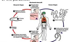 lymphatic filariasis